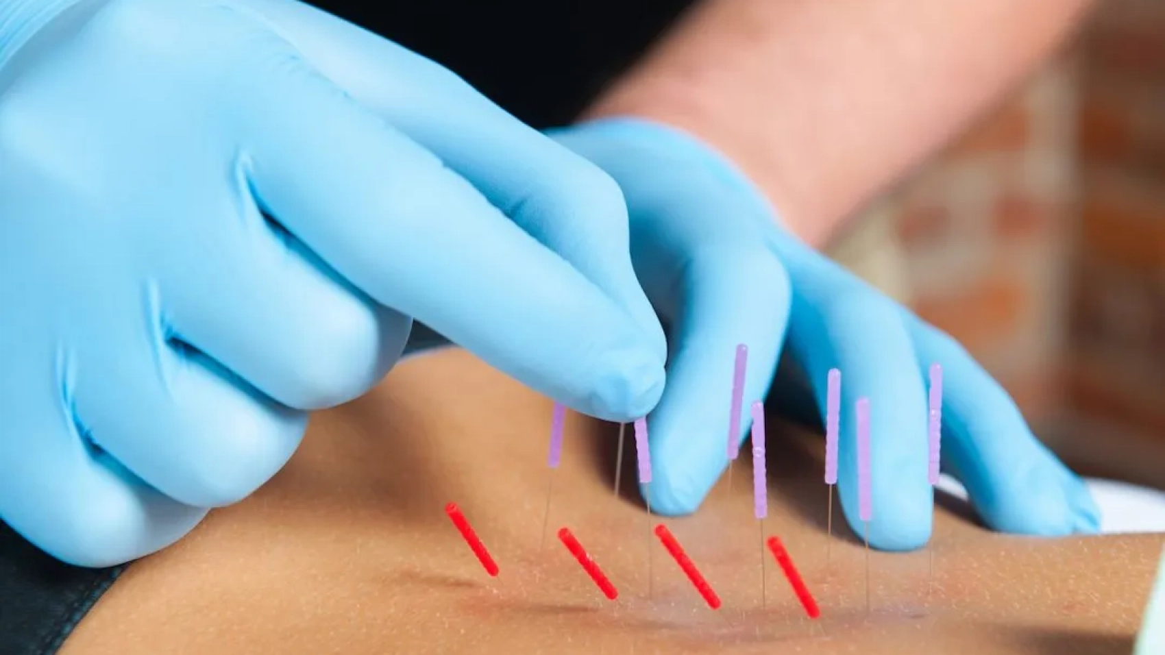 DRY-NEEDLING-1080x675-1920w